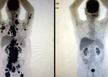 SUS estuda adoção de tratamento promissor contra câncer