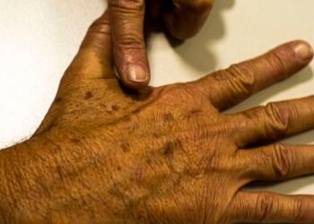 Tecnologia para tratar câncer de pele é aprovada para uso no SUS