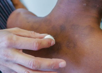 Filhos de isolados por hanseníase no passado vão receber pensão