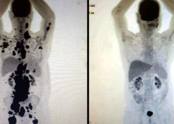 Entenda como funciona a terapia celular CAR-T Cell contra o câncer