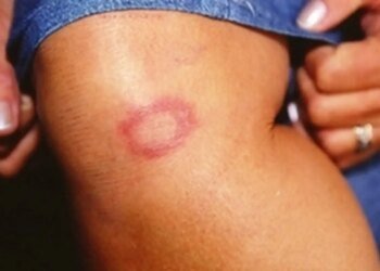 Hanseníase: conheça verdades e mitos sobre a doença